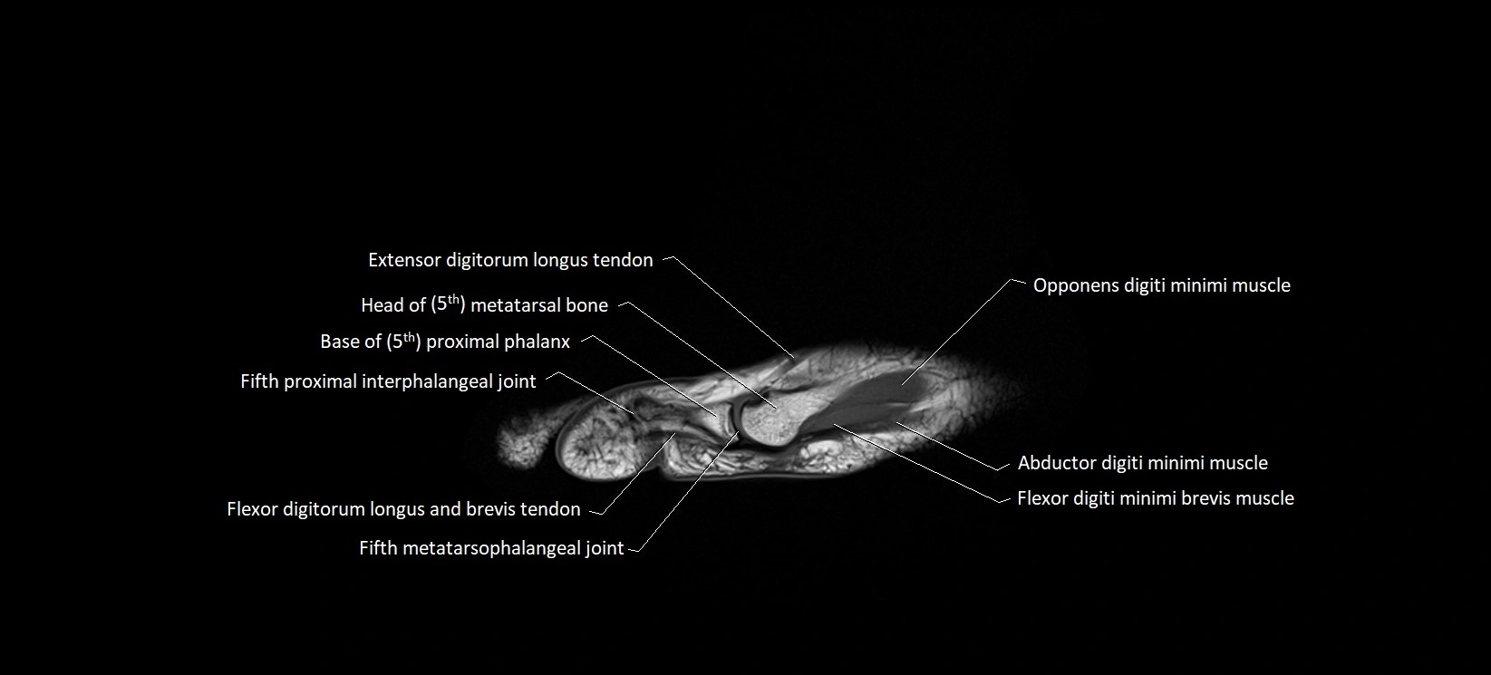 MRI foot sagittal labelled cross sectional anatomy image  24.webp